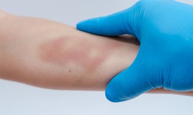 Hasil Pemeriksaan Korban Kekerasan, Kenali Apa yang Dimaksud dengan Visum